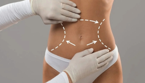 best liposuction in bangalore